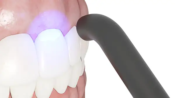 A 3D rendering of dental bonding being performed with a bonding light