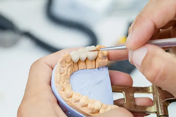A dental professional working on dental bridge placed on top of a model of a mouth A dental professional working on dental bridge placed on top of a model of a mouth