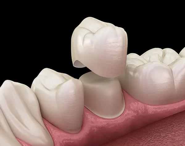 a 3D rendering of a dental crown being placed upon a tooth