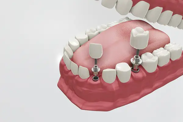 A 3d rendering of dental implants being placed in a mouth A 3d rendering of dental implants being placed in a mouth