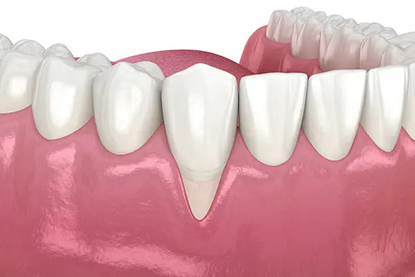 A 3D rendering showing gum recession due to periodontal disease
