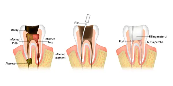 A diagram/drawing of a root canal procedure